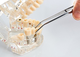 implant bridge on model replacing multiple missing teeth in Irving 
