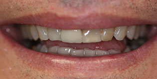 Closeup of dark colored teeth