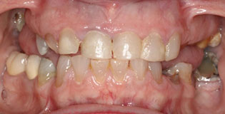 Closeup of damaged smile with several missing teeth