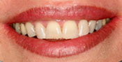 Closeup of woman's discolored teeth
