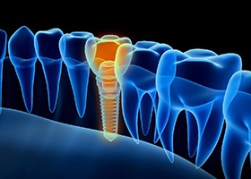 Digital x-ray illustration of dental implant in Irving