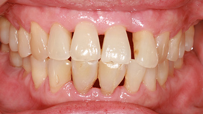 Closeup of patient's smile with gum disease