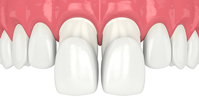 Illustration of two porcelain veneers placed over front teeth