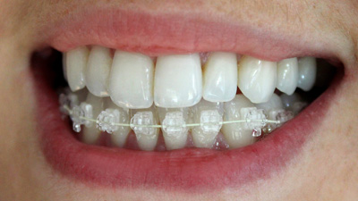 closeup of smile with Six Month Smiles braces in place