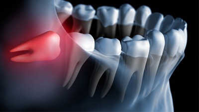 Image of an impacted wisdom tooth 