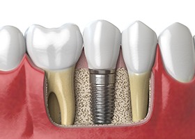 Diagram of dental implants in Irving after placement