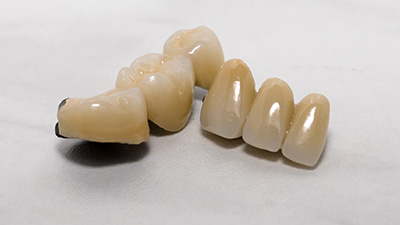Two dental bridges prior to placement