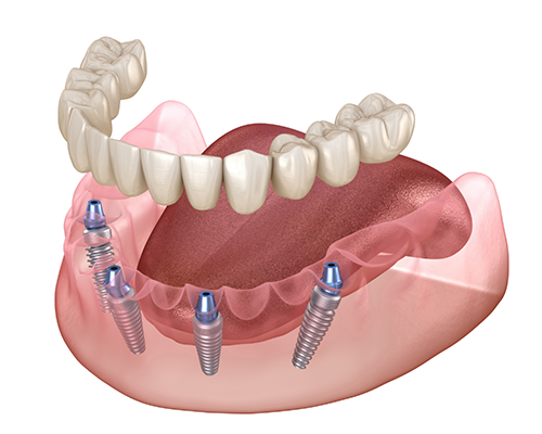 Illustration of All-on-4 implant dentures on both arches