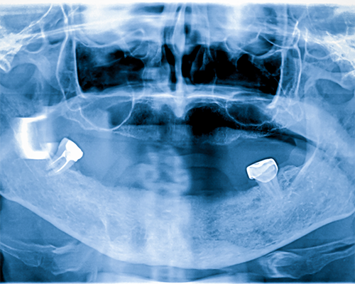 X-ray of a dental patient with only two teeth