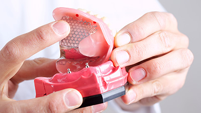 Model of All-on-4 denture
