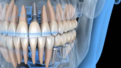 Illustrated view of jawbone with three traditional dental implants