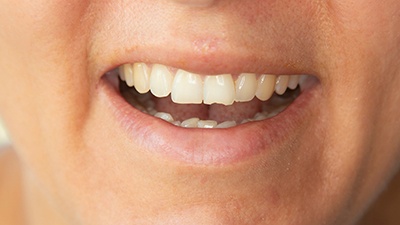 Man with a chipped tooth