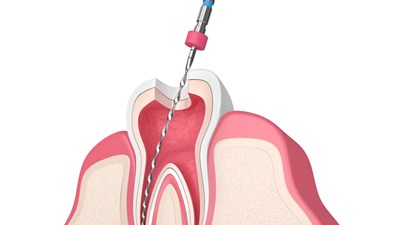 Root canal