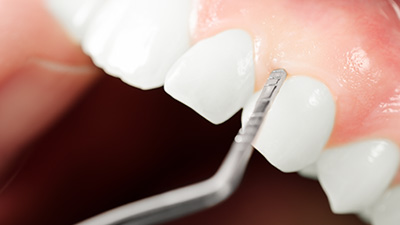 Closeup of smile during gum recontouring