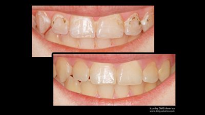 ICON white spot removal treatment before and after