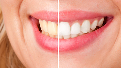 Closeup of teeth half before and half after whitening