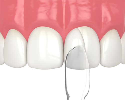 Illustration of a porcelain restoration being placed on a tooth