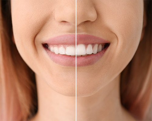 Woman smiling before and after gummy smile correction