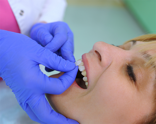 Dentist placing a veneer on a patient's tooth