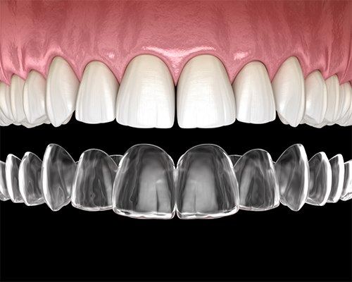 Illustration of a clear aligner being placed over a row of teeth