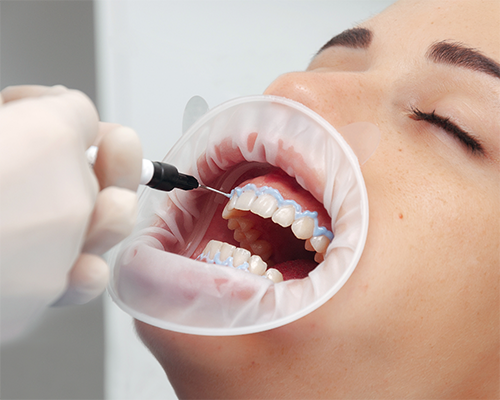 Woman getting teeth whitening at the dentist