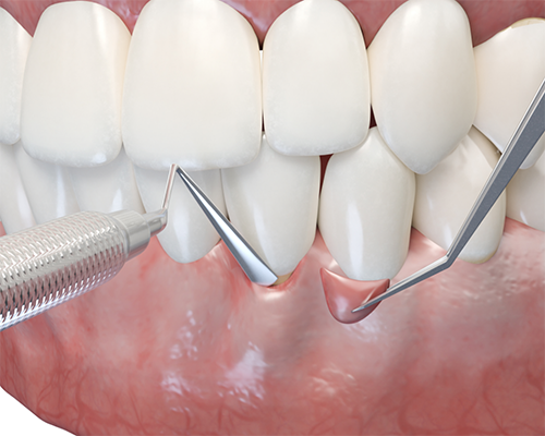 Illustration of cosmetic gum surgery