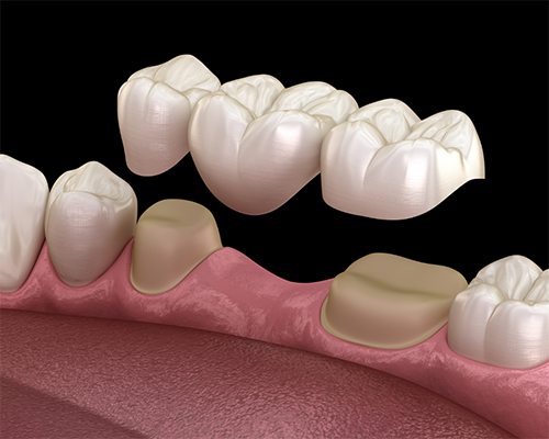 Illustration of dental bridge replacing missing tooth