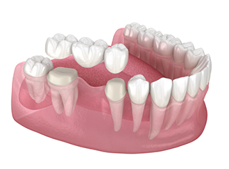 Illustration of a traditional dental bridge