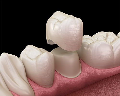 Illustration of a dental crown being placed over a tooth