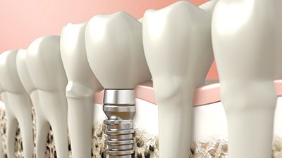 rendering of dental implants in Irving