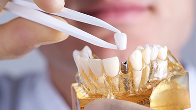 Model of implant supported dental crown