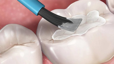 Animation of sealant placement