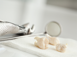 Three extracted teeth on a gauze pad