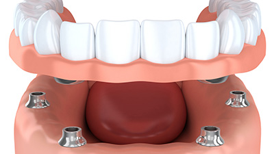 Animation of implant denture