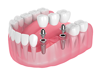 Illustration of a dental implant bridge