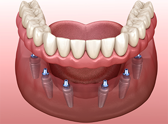 Illustration of an implant denture