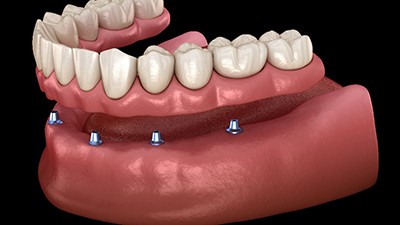 A 3D illustration of implant dentures