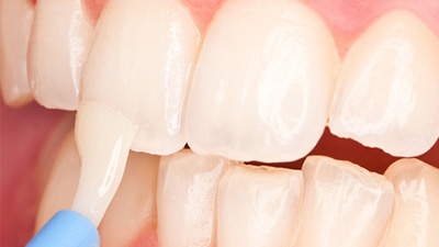 Closeup of teeth during fluoride application
