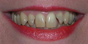 Closeup of older woman's misshapen teeth