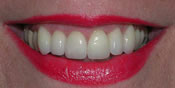 Closeup of older woman's perrfected smile
