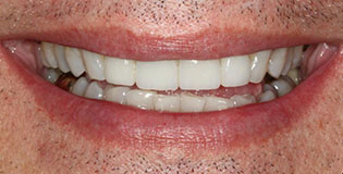 Closeup of brilliant white smile