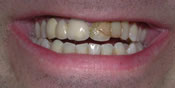 Closeup of man's smile with darkened front tooth