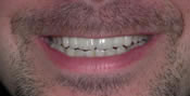 Closeup of man's bright white smile