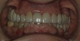 Closeup of repaired smile with replaced teeth