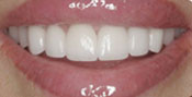 Closeup of woman's flawless white smile