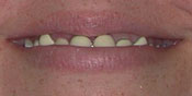 Closeup of woman's staained and chipped teeth