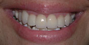 Closeup of woman's perfectly restored smile