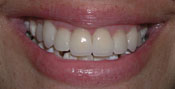 Closeup of woman's flawlesslt enhancedsmile