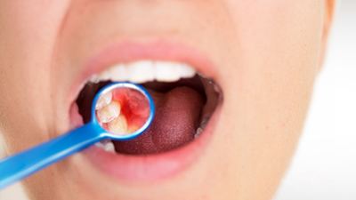 Open mouth with dental mirror showing inflamed gums