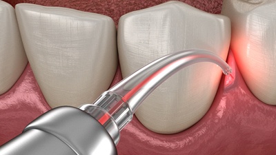 Illustration of laser being used for gum procedure